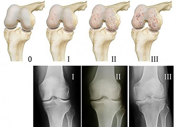 Обзор артроза коленного сустава 2 степени: особенности, симптомы и лечение