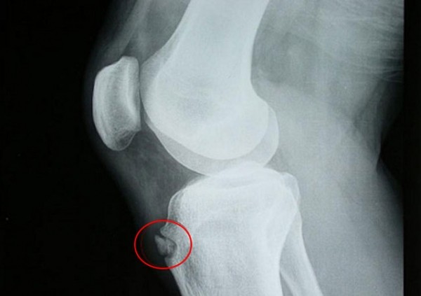 Обзор болезни Шляттера коленного сустава: симптомы и лечение