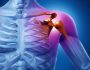 Растяжение связок плечевого сустава: причины и лечение