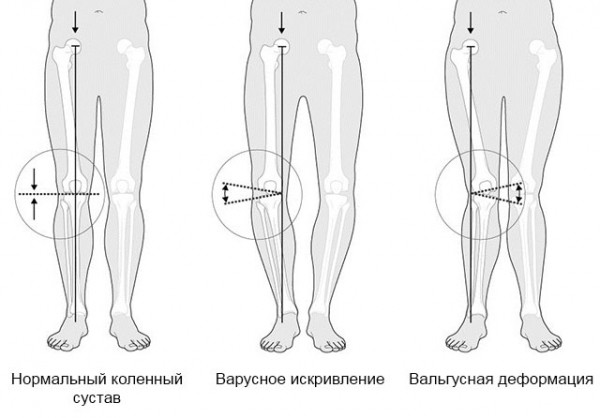 Вальгус коленных суставов у детей и взрослых: причины, диагностика, лечение
