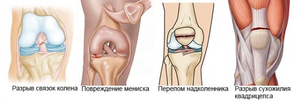 Какие бывают травмы колена, их симптомы, первая помощь и лечение