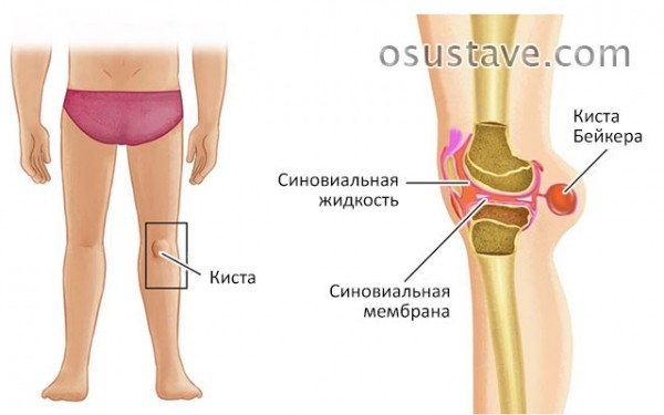 Боли под коленом сзади тянущего характера: причины, диагностика, лечение