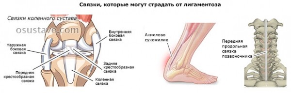 Обзор лигаментоза коленного сустава: механизм развития, признаки, лечение