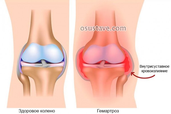 Какие бывают травмы колена, их симптомы, первая помощь и лечение