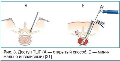 Особенности эндоскопической операции по удалению грыжи позвоночника