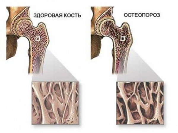 В чем разница между остеопорозом и остеохондрозом: как лечить эти болезни?
