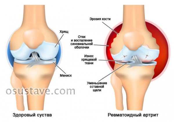 Боль в колене при сгибании и разгибании: почему возникает, диагностика, лечение