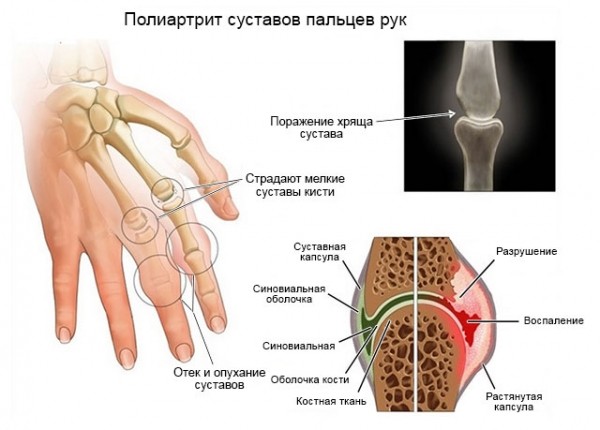 Полная характеристика полиартрита суставов: причины, симптомы и лечение