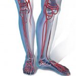 Атеросклероз нижних конечностей: симптомы и лечение, стадии