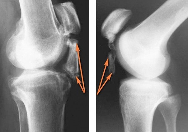 Обзор лигаментоза коленного сустава: механизм развития, признаки, лечение