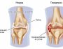 Симптомы и лечение гемартроза коленного сустава, причины, диагностика