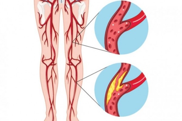 Атеросклероз нижних конечностей: симптомы и лечение, стадии