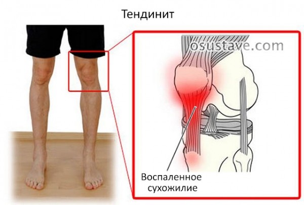 Боли под коленом сзади тянущего характера: причины, диагностика, лечение