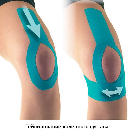 Кинезиотейпирование колена для защиты и восстановления сустава и связок