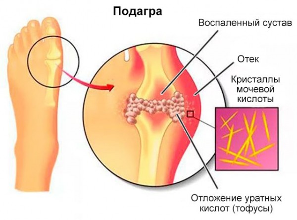 Полная характеристика полиартрита суставов: причины, симптомы и лечение