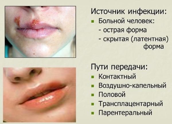 Последствия от герпеса на губе при беременности, лечение и профилактика