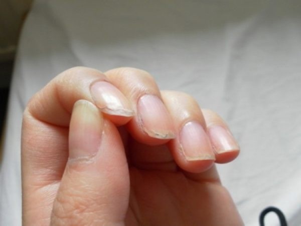 Почему слоятся ногти на руках и как укрепить ногтевую пластину в домашних условиях