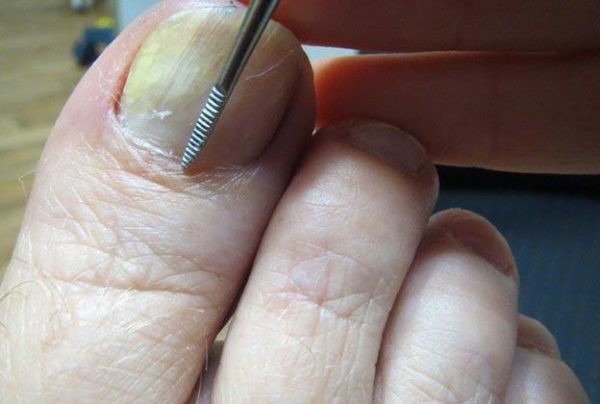 Наиболее вероятные причины появления темного пятна на ногте большого пальца ноги
