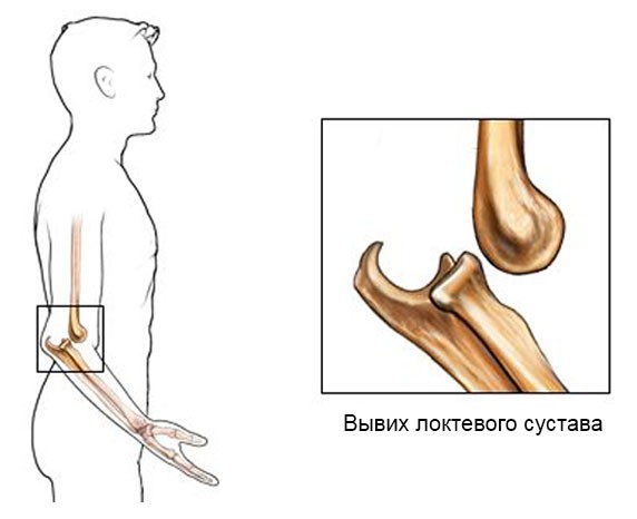 Обзор латерального эпикондилита локтевого сустава: симптомы, лечение