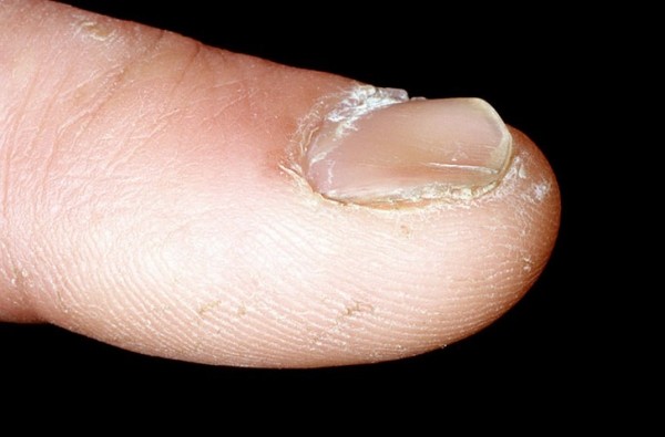 Причины и лечение расслаивающихся ногтей на руках