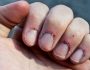 Почему образуются заусенцы на пальцах и можно ли их удалять