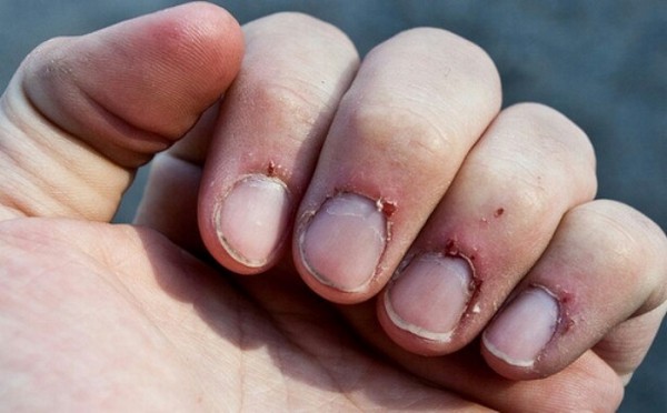Почему образуются заусенцы на пальцах и можно ли их удалять