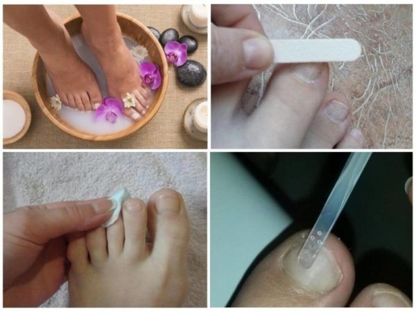 Обзор самых эффективных лаков от грибка ногтей
