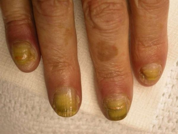 Причины и методы лечения желтых ногтей на руках у женщин
