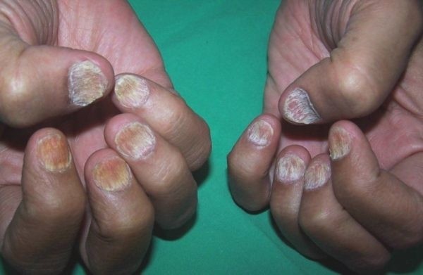 Почему слоятся ногти на руках и как укрепить ногтевую пластину в домашних условиях