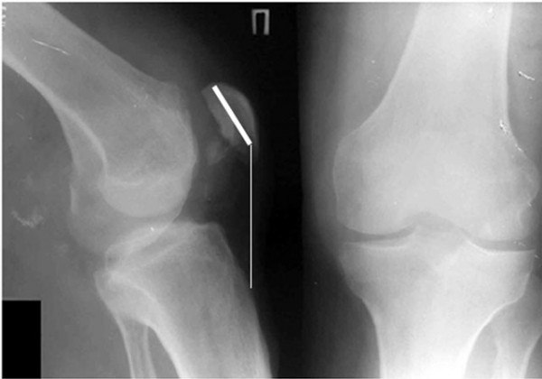 Перелом коленной чашечки (надколенника): симптомы, сроки лечения, последствия