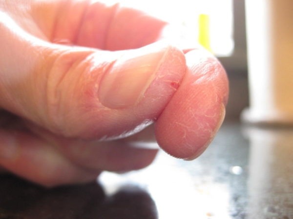 Почему появляются трещины на пальцах рук и как от них избавиться