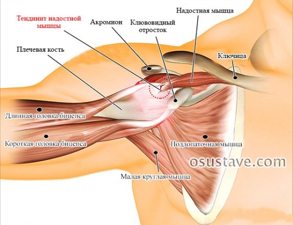 Полная характеристика тендинита сухожилия надостной мышцы плечевого сустава