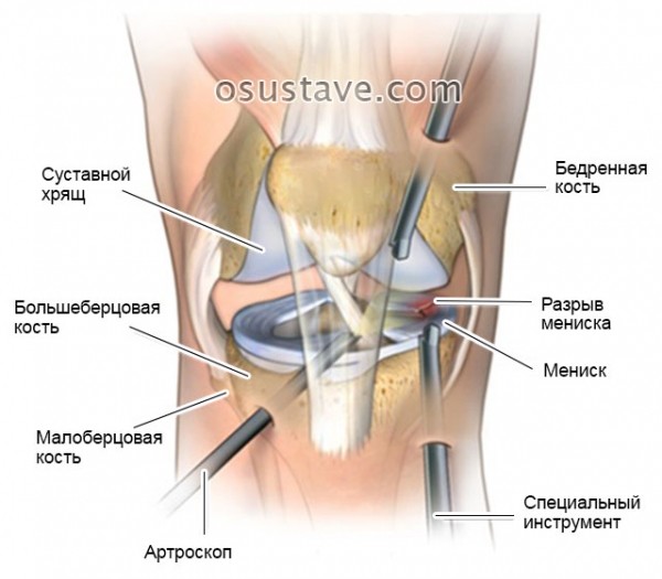 Что такое мениск коленного сустава, возможные повреждения, их причины и лечение