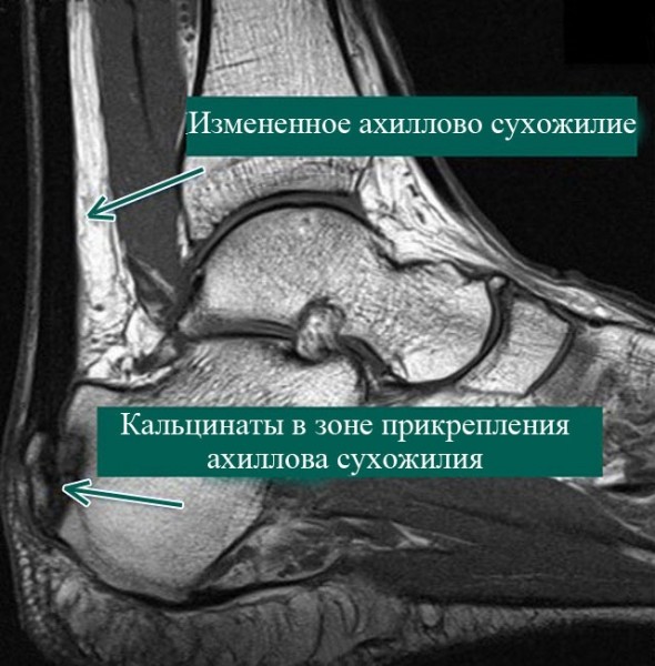 Боль в голеностопном суставе – обзор: при ходьбе, в покое, с внутренней стороны, без видимых причин