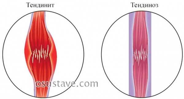 Полная характеристика тендинита сухожилия надостной мышцы плечевого сустава