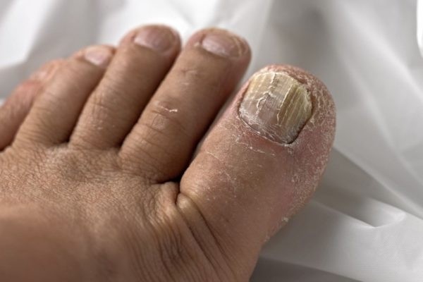 Какой врач занимается лечением грибка ногтей на ногах