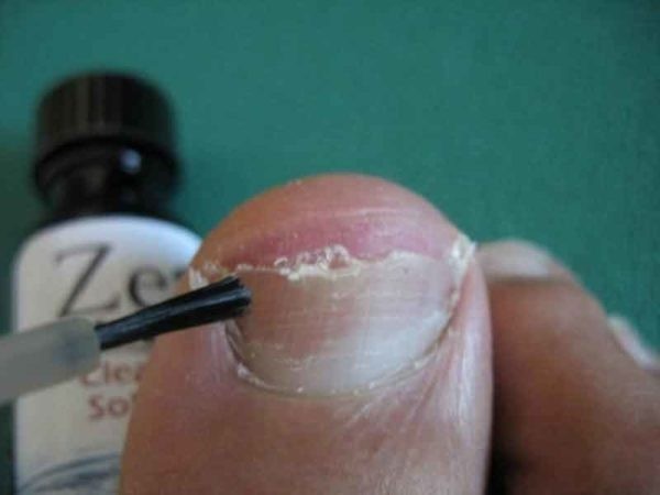 Обзор самых эффективных лаков от грибка ногтей