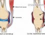 Полный обзор анкилоза суставов: причины и лечение