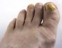 Основные причины и лечение желтизны ногтей на ногах