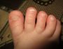 Причины и способы лечения отслоения ногтей на ногах