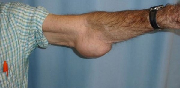 Опухоль (шишка) на локтевом суставе: что это может быть, сопутствующие симптомы, лечение