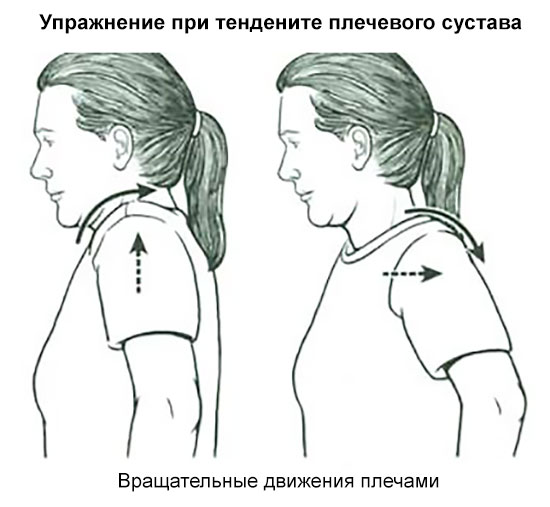 Обзор тендинита плечевого сустава: виды, симптомы и лечение