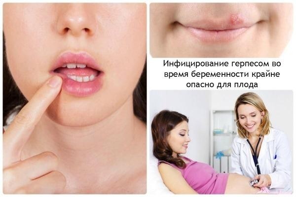 Последствия от герпеса на губе при беременности, лечение и профилактика