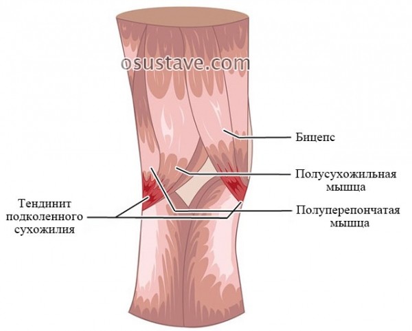 Причины боли под коленом сзади и при сгибании, причины и лечение