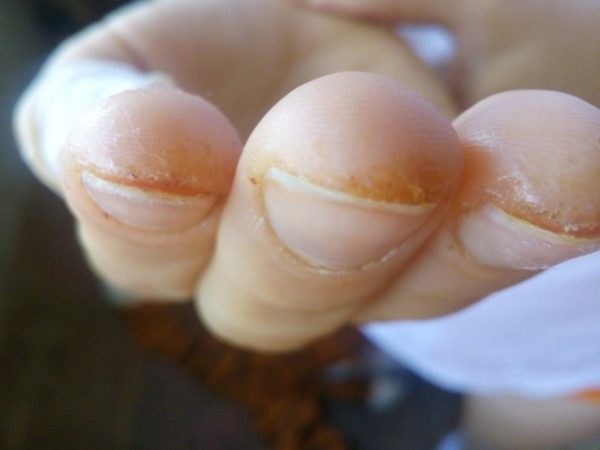 Почему появляются трещины на пальцах рук и как от них избавиться