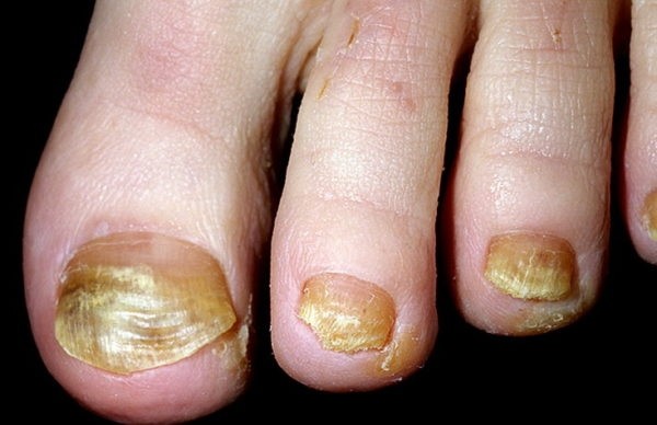 Основные причины и лечение желтизны ногтей на ногах