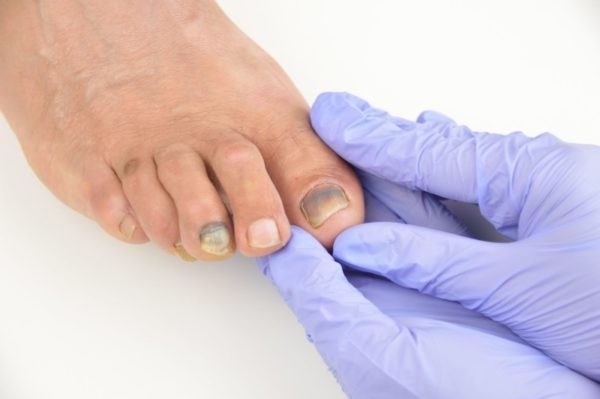 Какой врач занимается лечением грибка ногтей на ногах