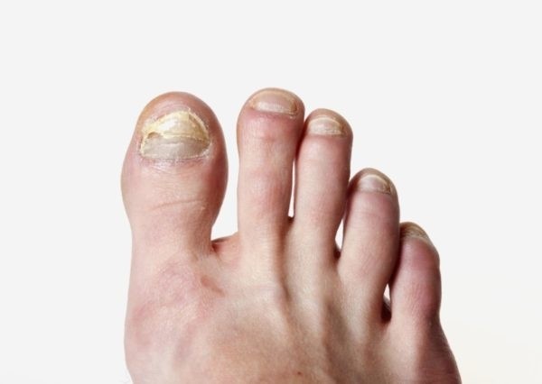 Особенности применения Флуконазола при лечении грибка ногтей на ногах