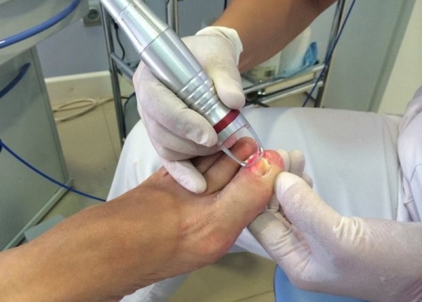 Как проводят процедуру удаления ногтя при онихомикозе