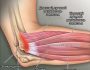 Обзор латерального эпикондилита локтевого сустава: симптомы, лечение